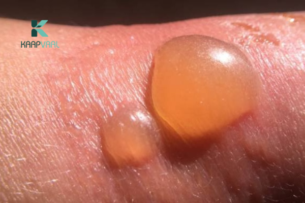 bị bỏng có nên làm vỡ bọng nước không