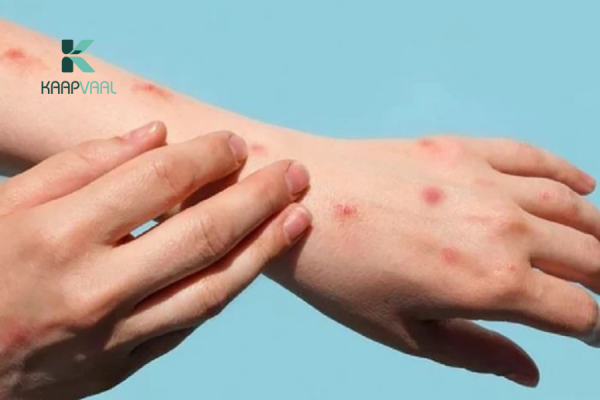 Sẹo do thuỷ đậu