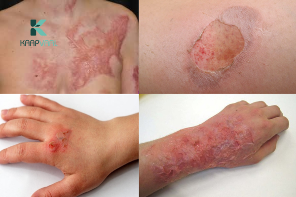 Phân loại các loại bỏng