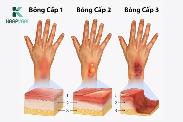 Phân Loại Mức Độ Bỏng Nhiệt