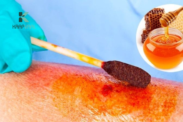 Bị bỏng bôi mật ong được không?