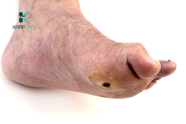 Loét tiểu đường