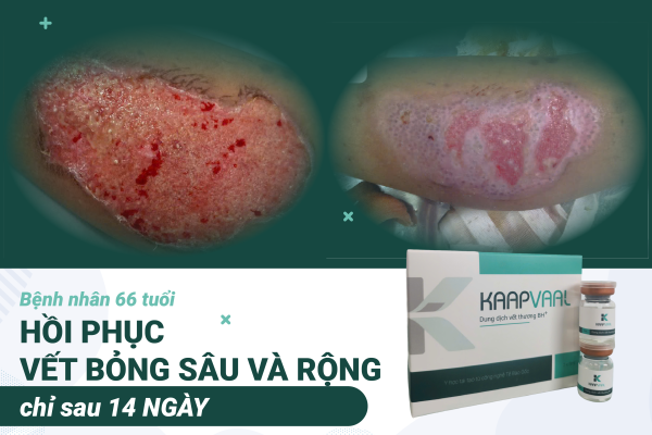 Hiệu quả điều trị bỏng bô nặng bằng dung dịch Kaapvaal BH+