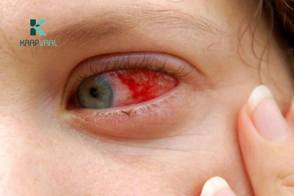 Bệnh Võng Mạc Tiểu Đường