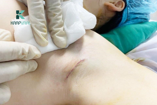 Chăm sóc vết mổ sau phẫu thuật