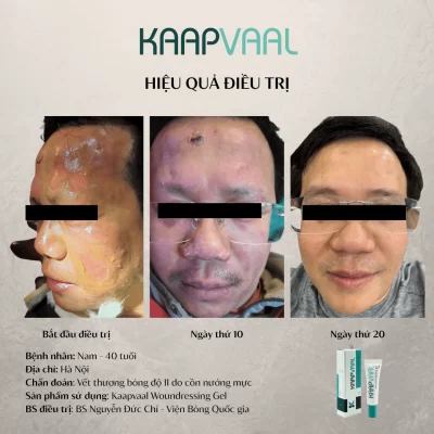 Chữa liền vết bỏng độ II do tai nạn nướng mực bằng cồn sau 20 ngày