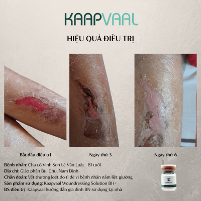 Điều trị thành công loét tì đè cho bệnh nhân 81 tuổi