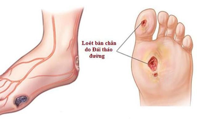 hình ảnh minh họa loét tiểu đường