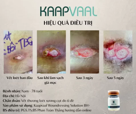 Điều trị vết loét vùng xương cụt bằng Kaapvaal Woundressing Solution BH+