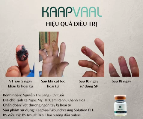 "Tạm biệt" hoại tử ngón tay sau khâu