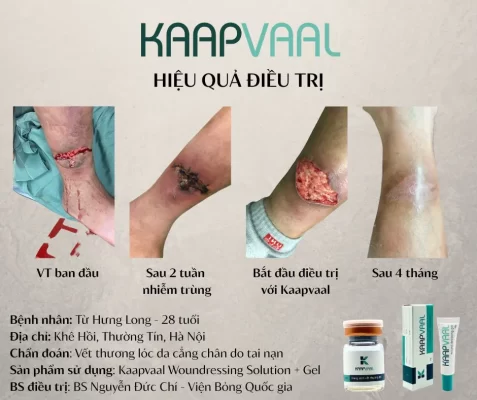 Chữa khỏi vết thương 1 năm không lành chỉ sau 4 tháng