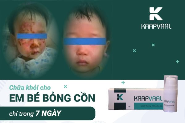 Chữa khỏi cho em bé bỏng cồn chỉ trong vòng 7 ngày