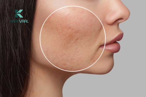 Sẹo lõm có trị được không? – Giải đáp từ chuyên gia