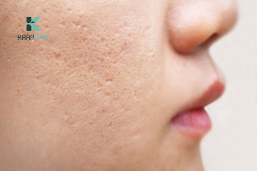 Sẹo rỗ đáy nhọn