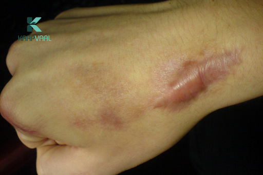 sẹo lồi ngày càng to