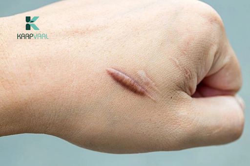 Sẹo lồi có to lên không