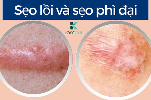 Phân biệt sẹo lồi và sẹo phì đại