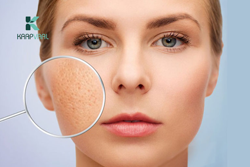 Sẹo lõm có tự đầy không?