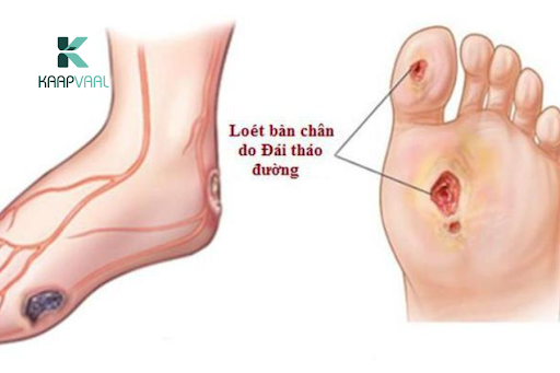 Bị tiểu đường lở loét chân