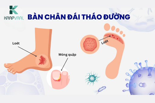 Bệnh lý bàn chân tiểu đường