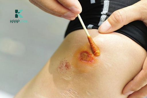 Vết thương nhiễm trùng là gì?