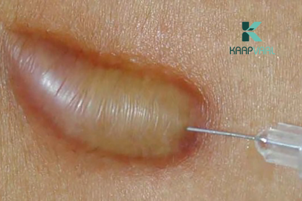 Thuốc tiêm sẹo lồi