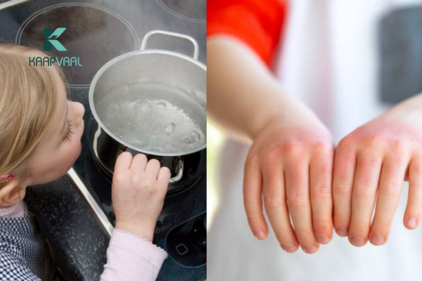 cách trị bỏng nước sôi tại nhà