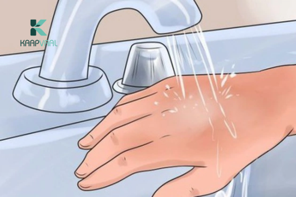 cách chăm sóc vết bỏng