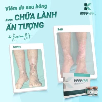 VIÊM DA SAU BỎNG ĐƯỢC CHỮA LÀNH ẤN TƯỢNG NHỜ KAAPVAAL BH+ CHỈ SAU 2 THÁNG