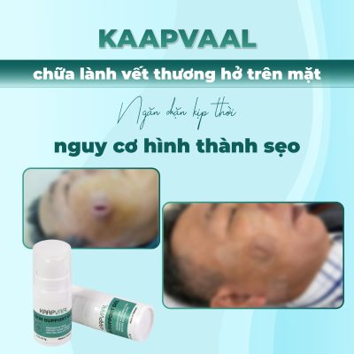 Kaapvaal chữa lành vết thương hở trên mặt và ngăn ngừa sẹo xấu kịp thời