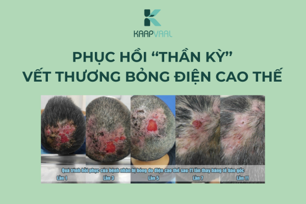 Phục hồi ''thần kỳ'' vết thương bỏng điện cao thế