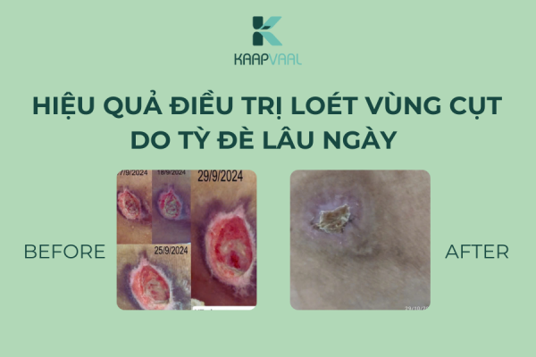 Hiệu quả điều trị loét vùng cụt do tỳ đè lâu ngày