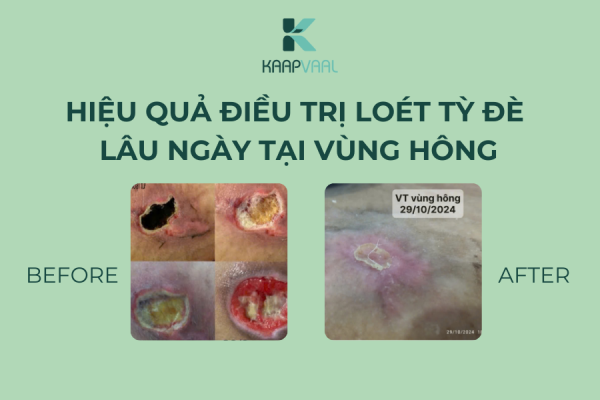 Hiệu quả điều trị loét tỳ đè lâu ngày tại vùng hông