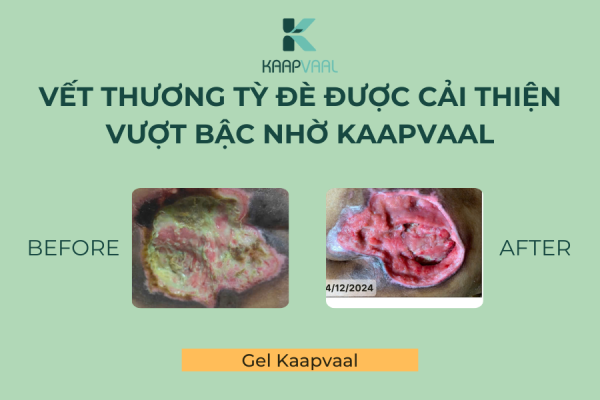 Vết thương tỳ đè được cải thiện vượt bậc nhờ Kaapvaal