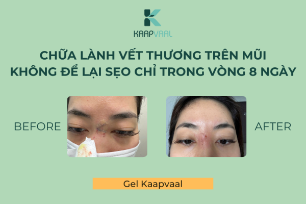 Chữa lành vết thương trên mũi không để lại sẹo chỉ trong vòng 8 ngày