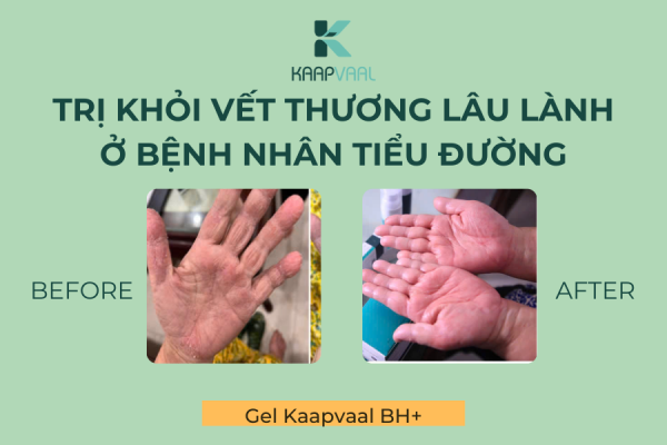 Trị khỏi vết thương lâu lành ở bệnh nhân tiểu đường - Chỉ cần 20 ngày