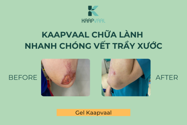 Kaapvaal chữa lành nhanh chóng vết trầy xước