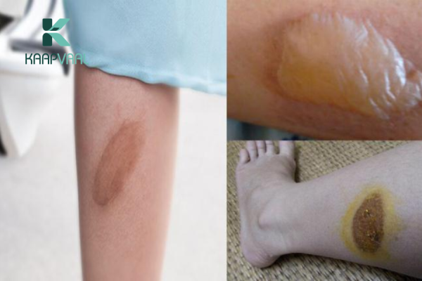 Bỏng bô xe máy bị phồng nước