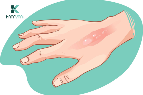 cách sơ cứu bỏng nước sôi