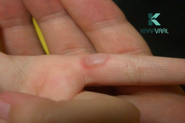 Vết bỏng bị phồng có nên chọc nước ra không?