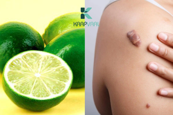 cách trị sẹo lồi tại nhà