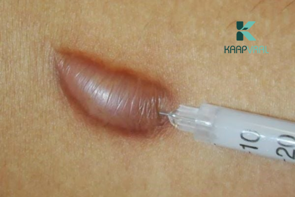 Các phương pháp điều trị sẹo lồi hiệu quả, an toàn