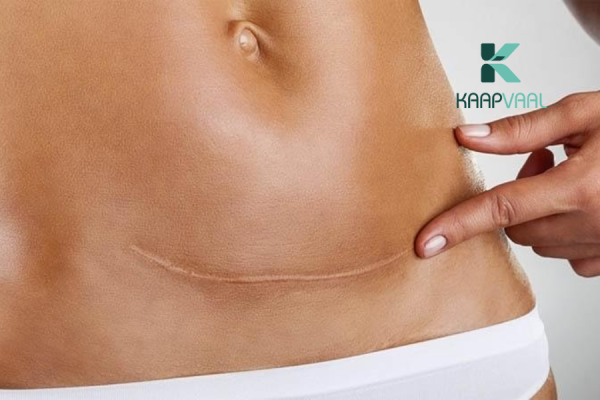 Làm thế nào để trị sẹo lồi sau phẫu thuật?