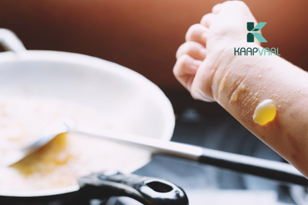 Cách sơ cứu khi bị bỏng dầu