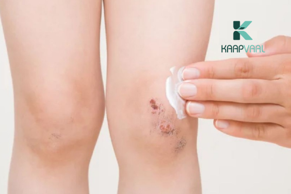 Vết thương bị căng da có sao không?