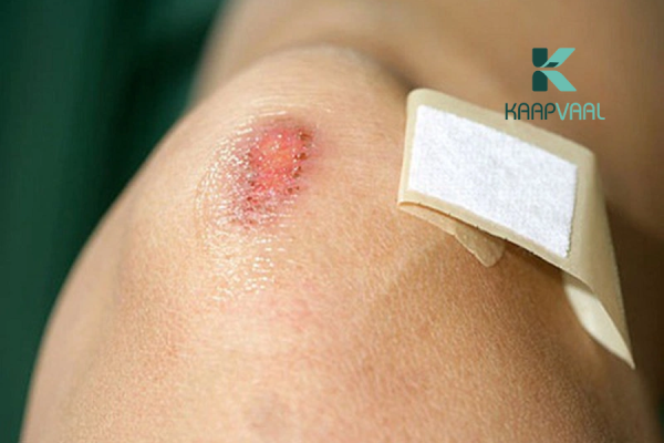 Vết thương bị nhức