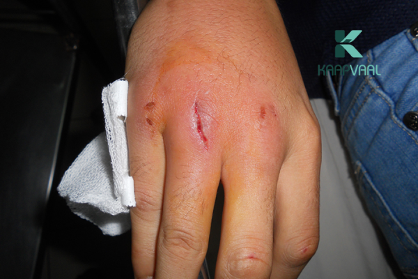 Vết thương bị phù nề