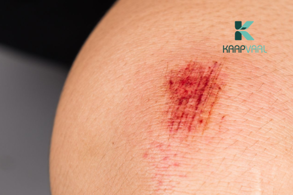 Vết thương bị đỏ