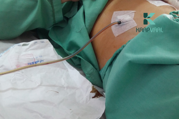 Chăm sóc vết thương có ống dẫn lưu