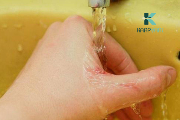 Vết thương hở có nên tắm không?